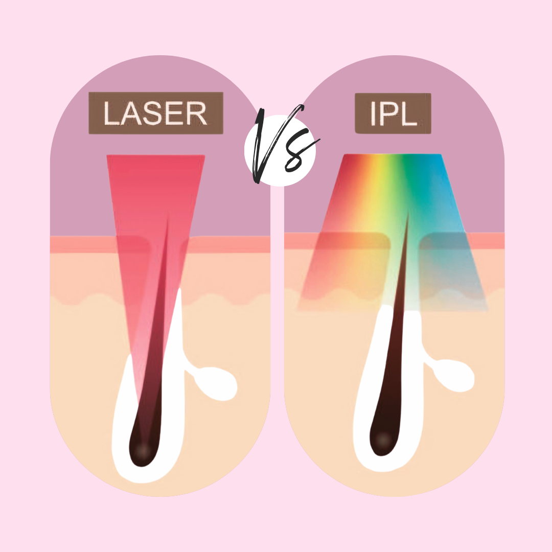 Laserontharen vs. IPL: wat zijn de verschillen?